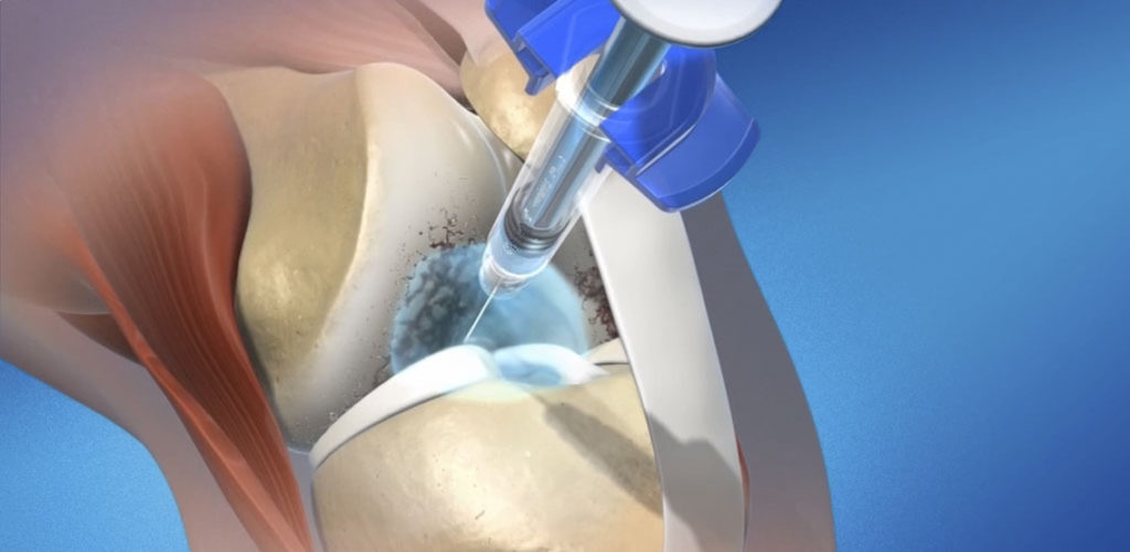 Гиалуроновая кислота: что это такое, для чего и как принимать